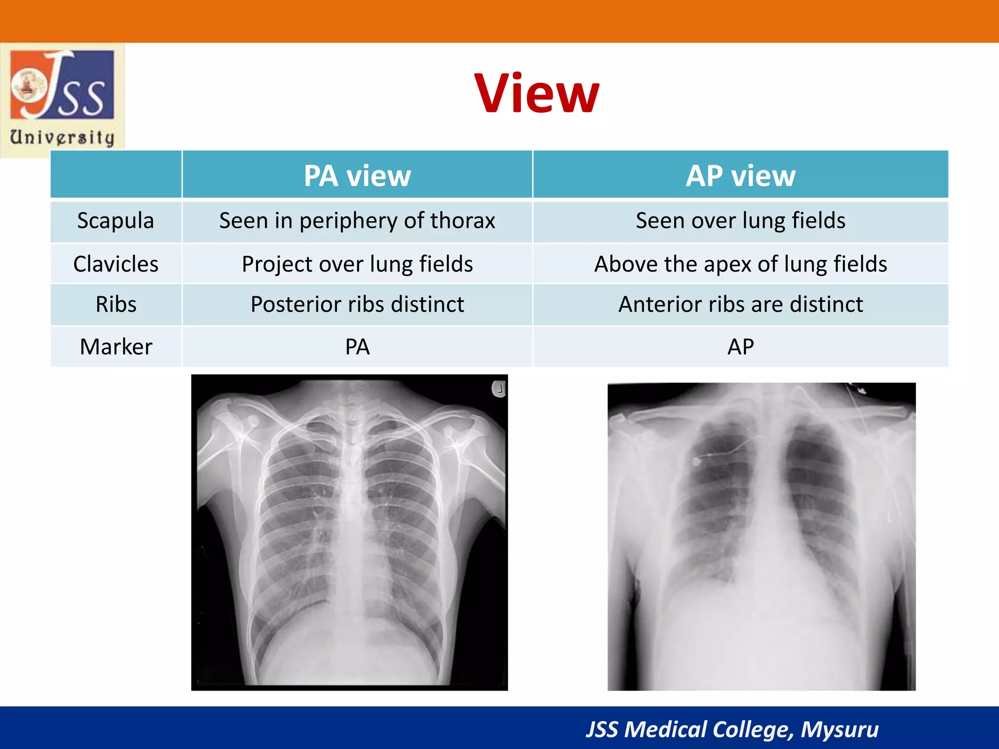 JSS Medical College, Mysuru
PA view AP view
Scapula Seen in periphery of thorax Seen over lung fields
Clavicles Project over lung fields Above the apex of lung fields
Ribs Posterior ribs distinct Anterior ribs are distinct
Marker PA AP
View
 