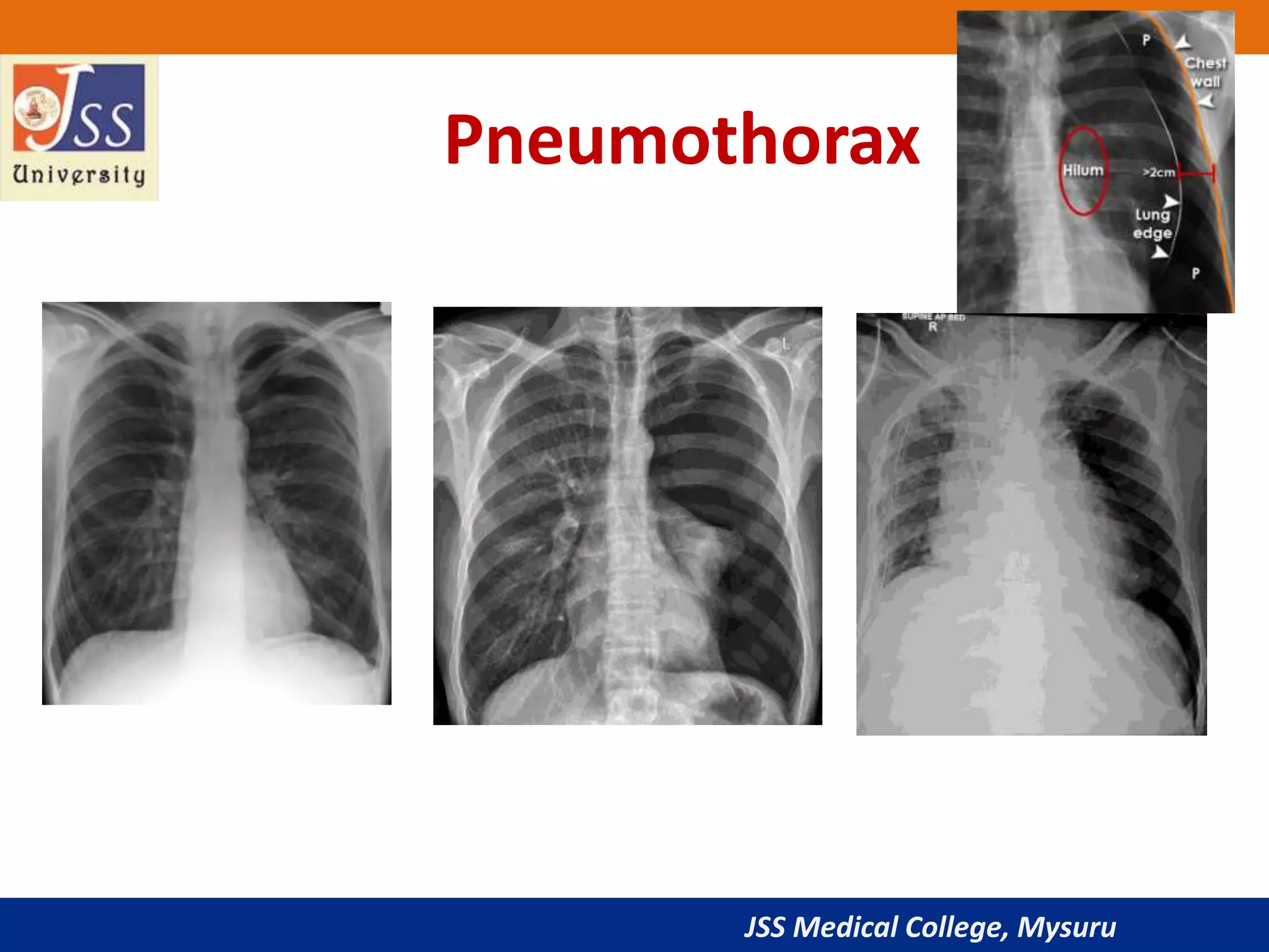 JSS Medical College, Mysuru
Pneumothorax
 