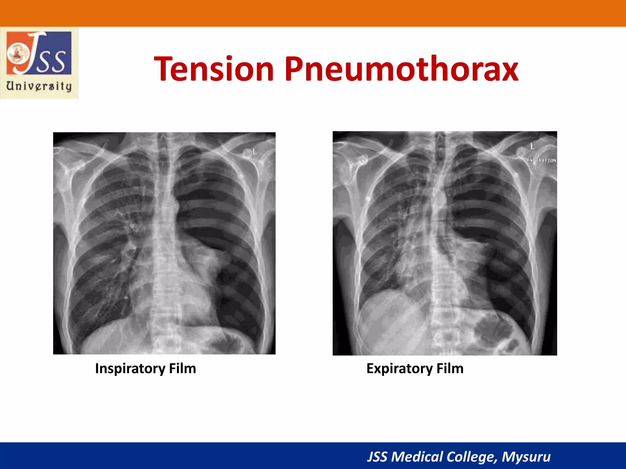 JSS Medical College, Mysuru
Tension Pneumothorax
Inspiratory Film Expiratory Film
 