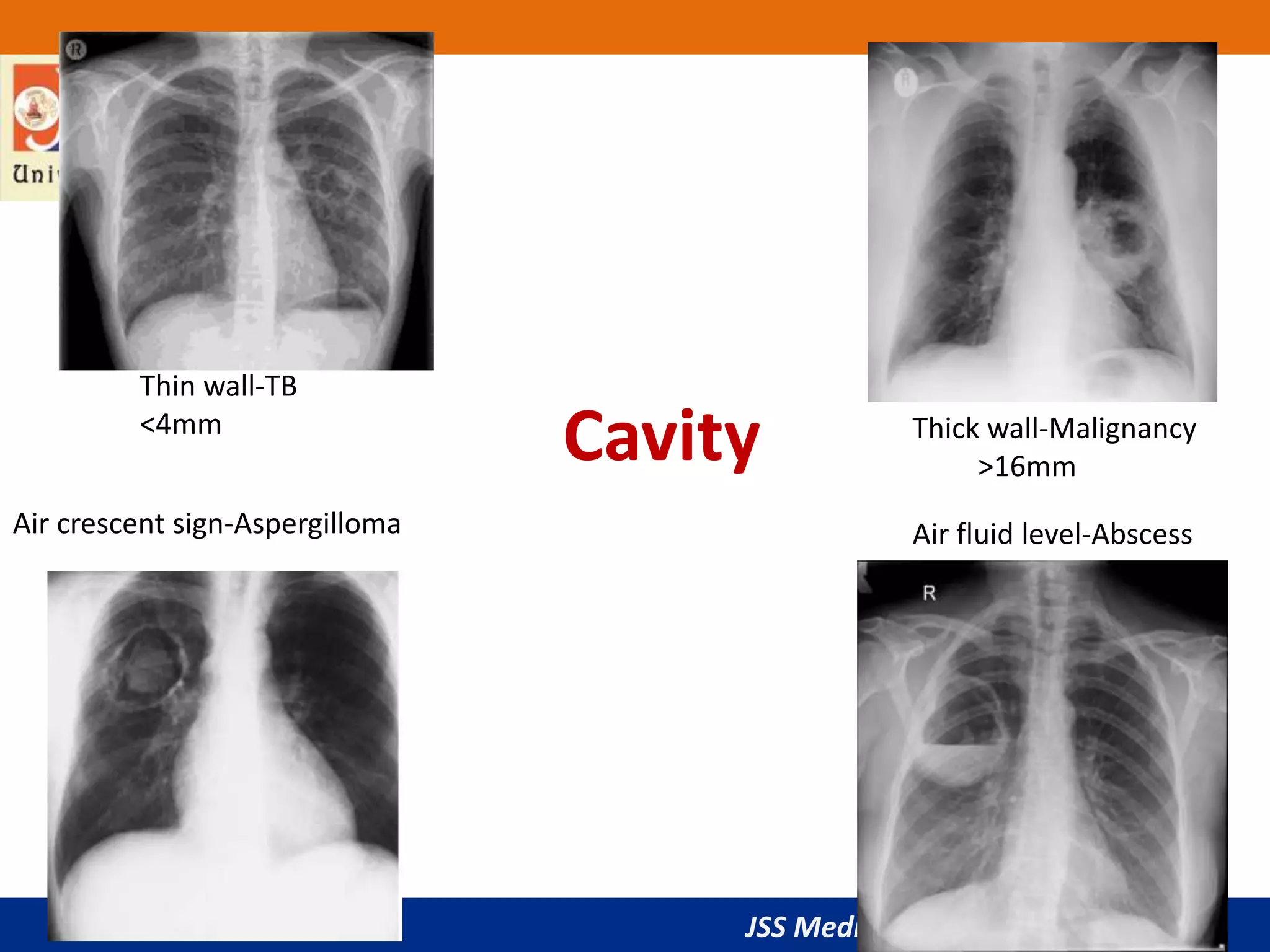 JSS Medical College, Mysuru
Cavity
Thin wall-TB
<4mm Thick wall-Malignancy
>16mm
Air crescent sign-Aspergilloma Air fluid level-Abscess
 