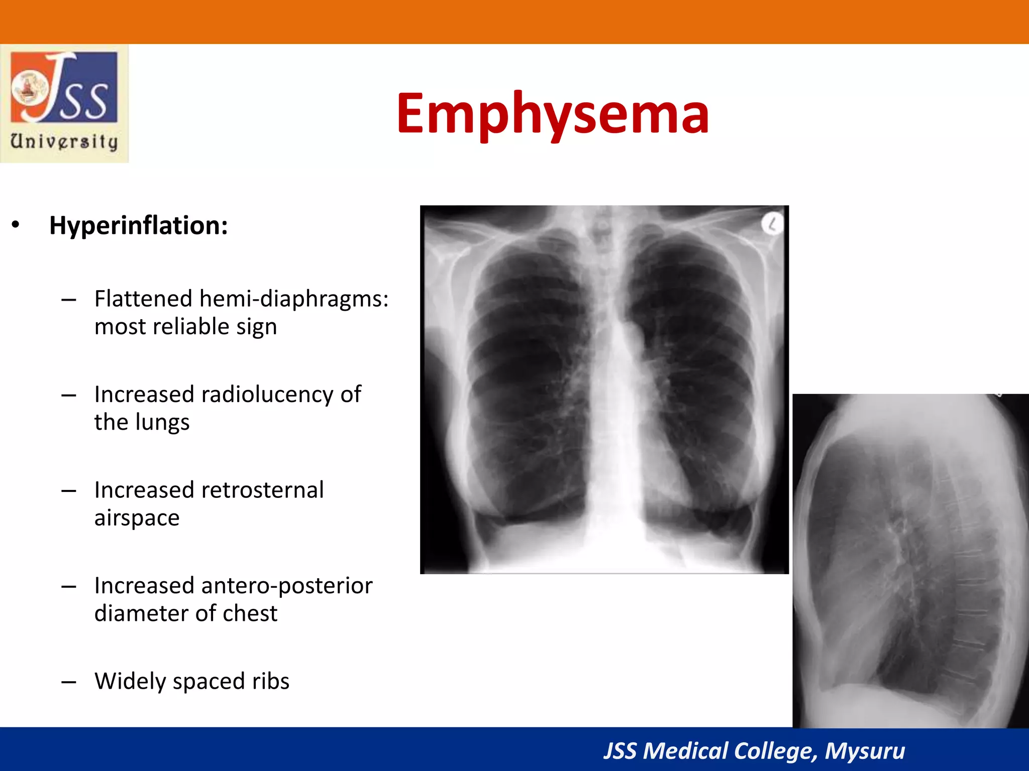 JSS Medical College, Mysuru
Emphysema
• Hyperinflation:
– Flattened hemi-diaphragms:
most reliable sign
– Increased radiolucency of
the lungs
– Increased retrosternal
airspace
– Increased antero-posterior
diameter of chest
– Widely spaced ribs
 