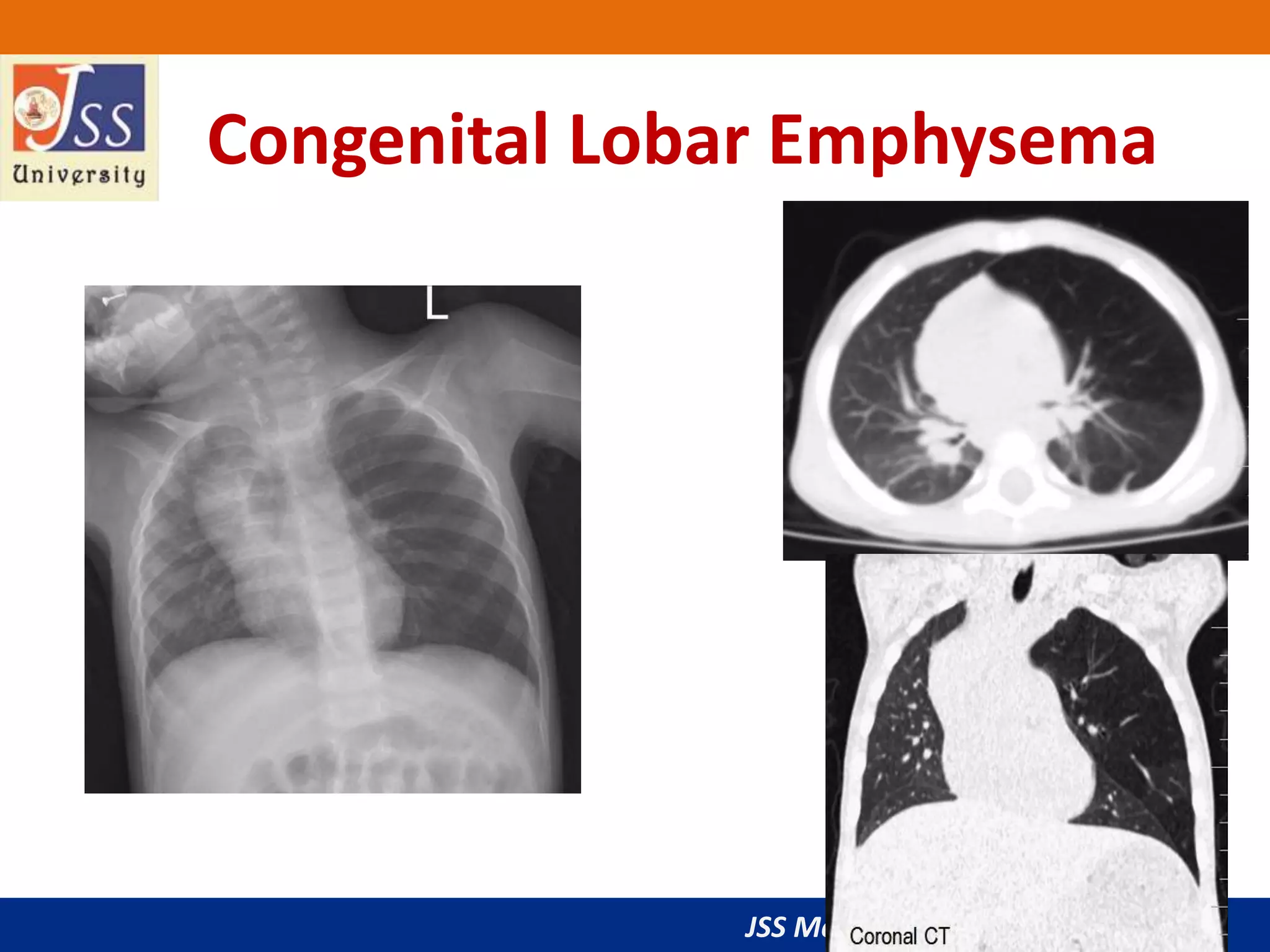 JSS Medical College, Mysuru
Congenital Lobar Emphysema
 