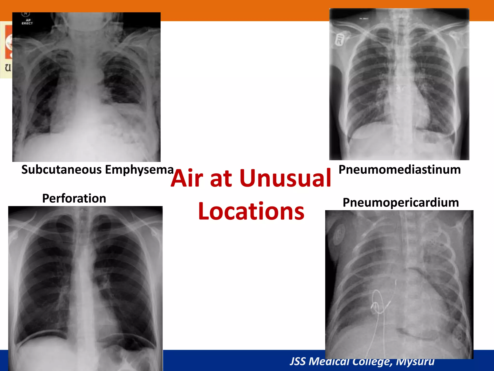 JSS Medical College, Mysuru
Air at Unusual
Locations
Subcutaneous Emphysema
Perforation
Pneumomediastinum
Pneumopericardium
 