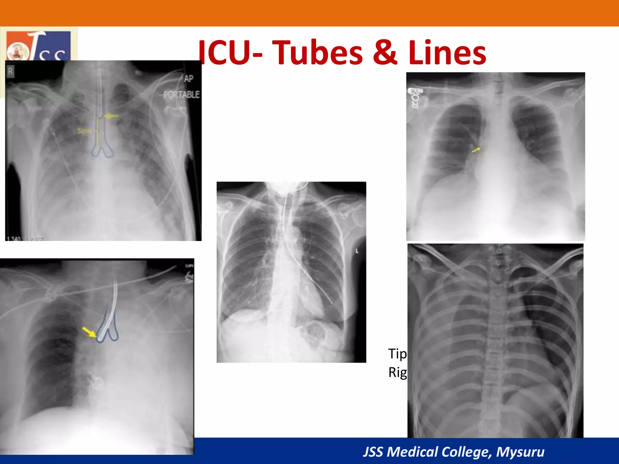 JSS Medical College, Mysuru
ICU- Tubes & Lines
Tip at Junction of SVC &
Right atrium
 