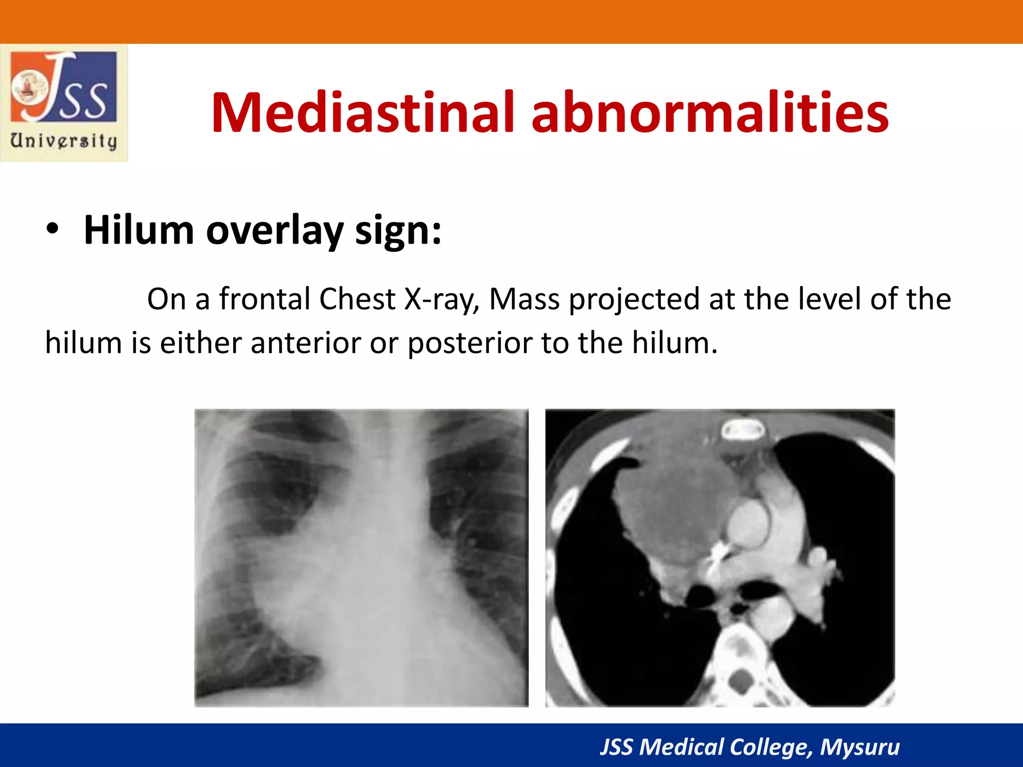 JSS Medical College, Mysuru
Mediastinal abnormalities
• Hilum overlay sign:
On a frontal Chest X-ray, Mass projected at the level of the
hilum is either anterior or posterior to the hilum.
 