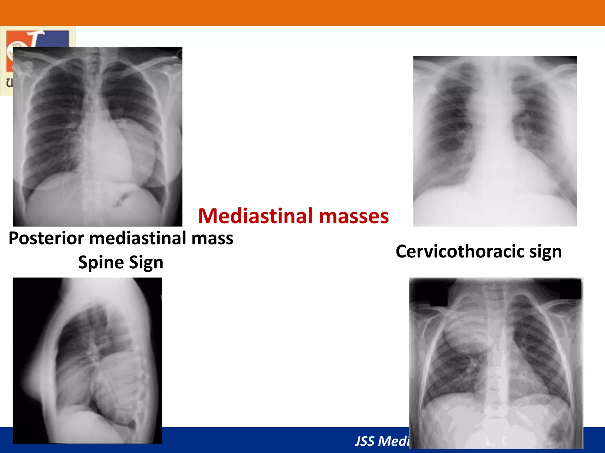 JSS Medical College, Mysuru
Posterior mediastinal mass
Spine Sign
Cervicothoracic sign
Mediastinal masses
 