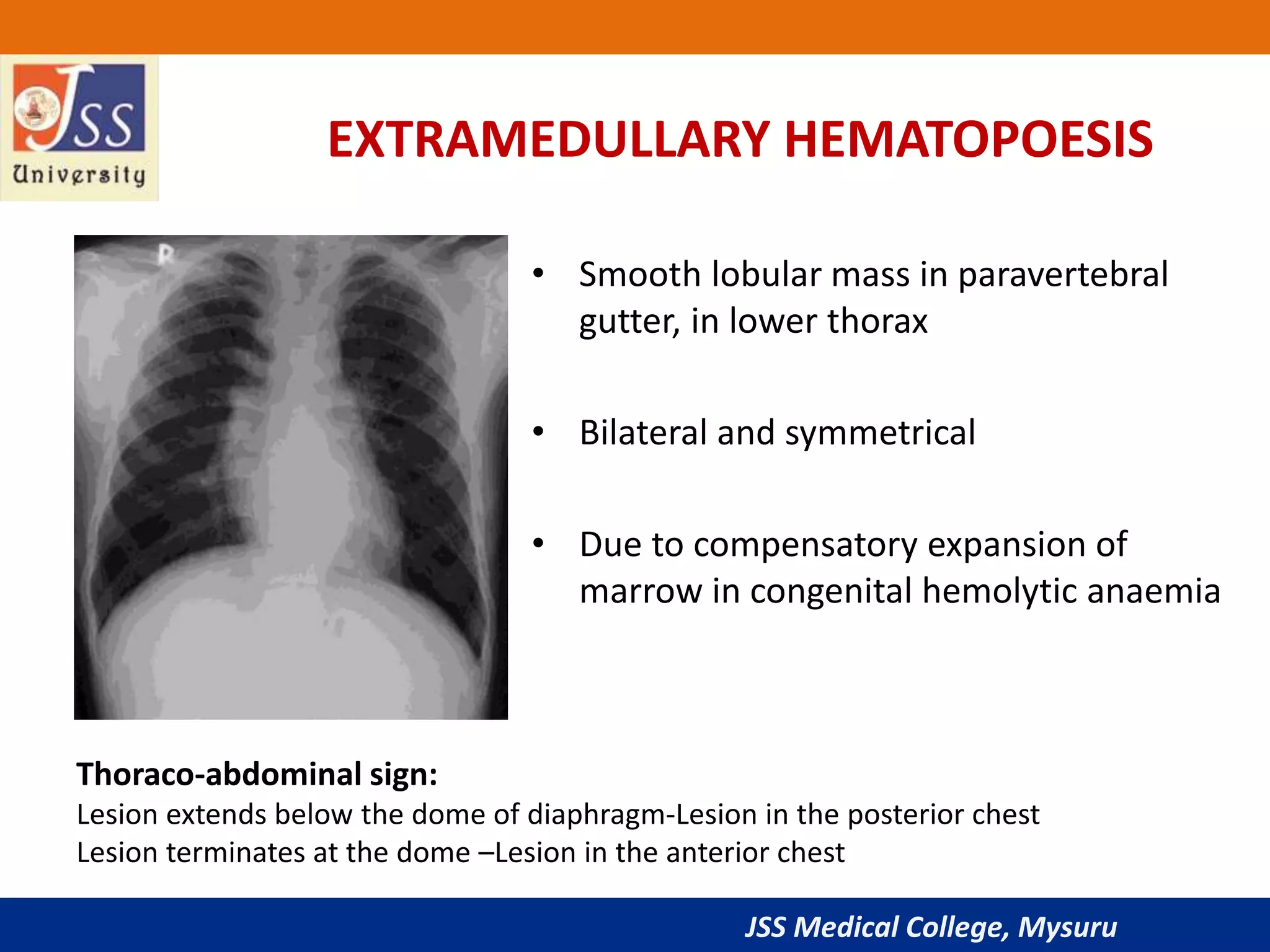 JSS Medical College, Mysuru
EXTRAMEDULLARY HEMATOPOESIS
• Smooth lobular mass in paravertebral
gutter, in lower thorax
• Bilateral and symmetrical
• Due to compensatory expansion of
marrow in congenital hemolytic anaemia
Thoraco-abdominal sign:
Lesion extends below the dome of diaphragm-Lesion in the posterior chest
Lesion terminates at the dome –Lesion in the anterior chest
 
