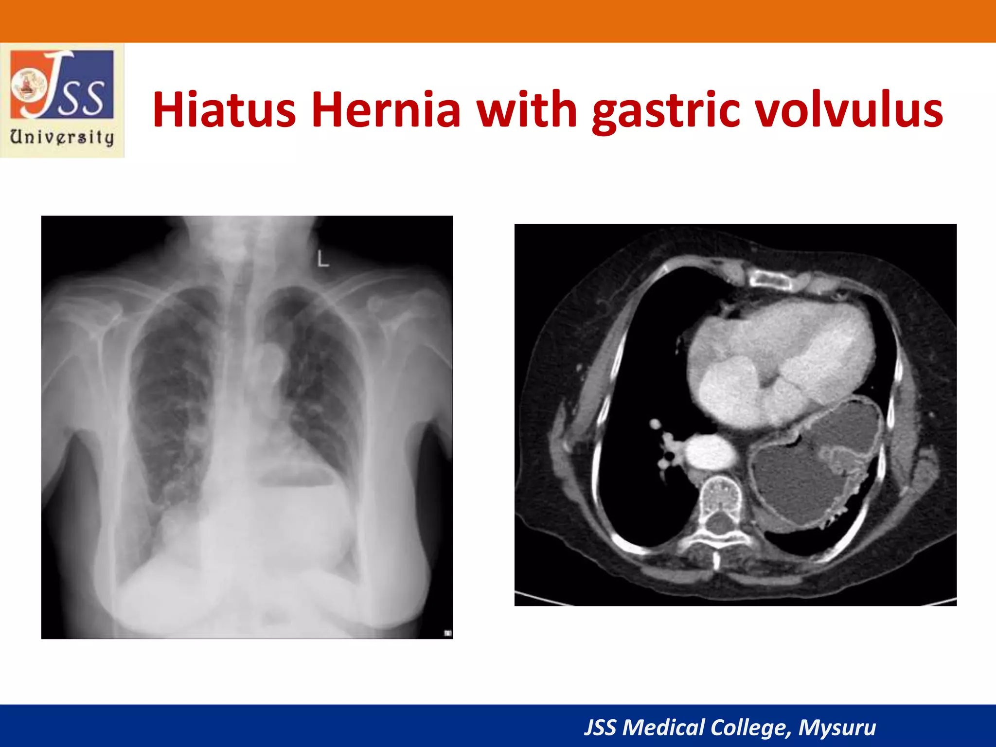 JSS Medical College, Mysuru
Hiatus Hernia with gastric volvulus
 