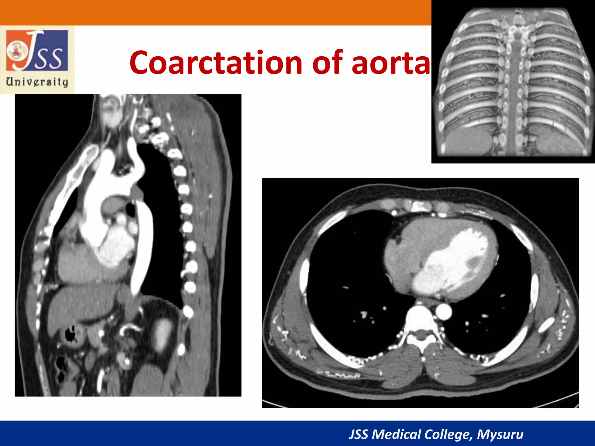 JSS Medical College, Mysuru
Coarctation of aorta
 