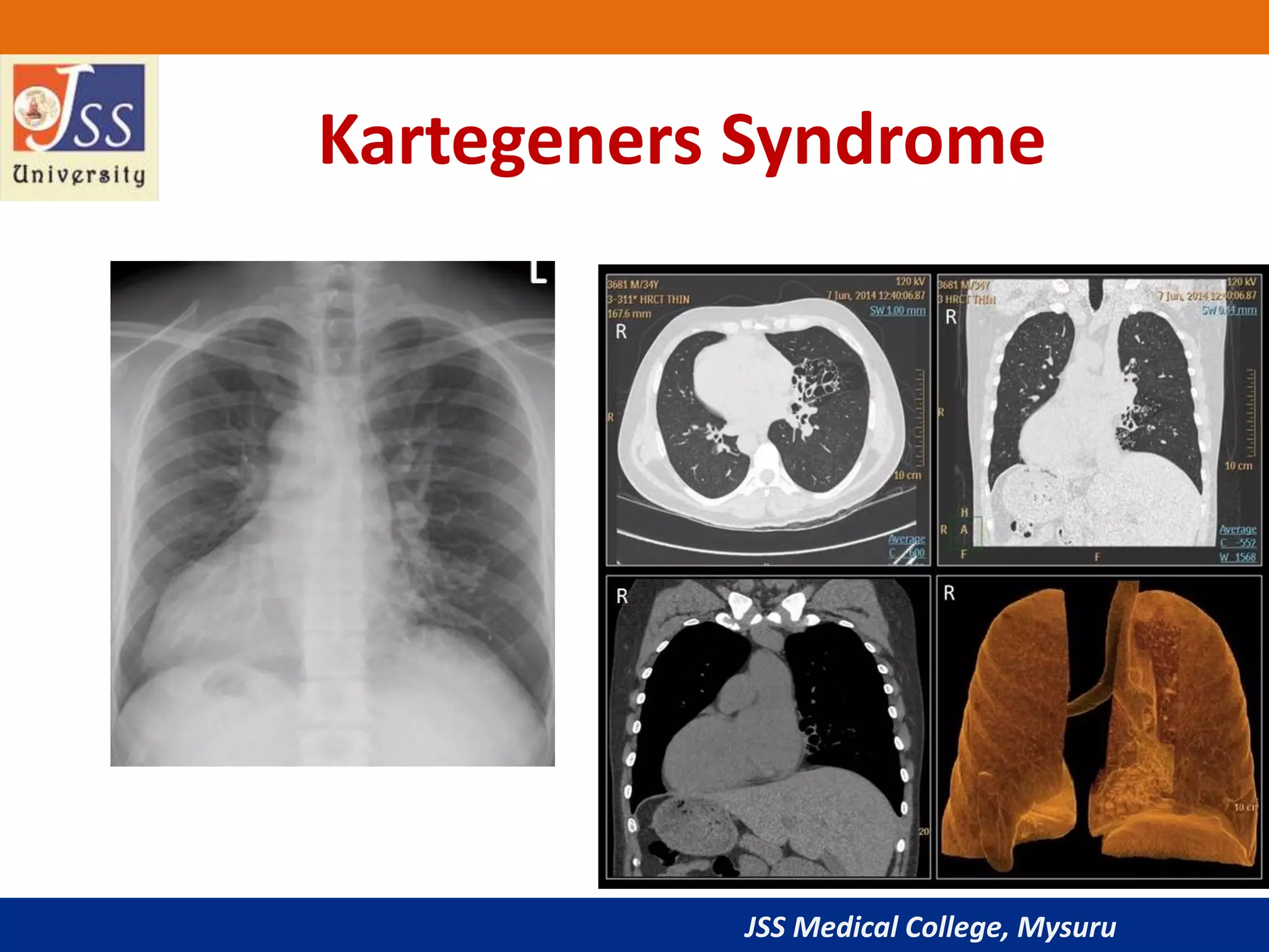 JSS Medical College, Mysuru
Kartegeners Syndrome
 