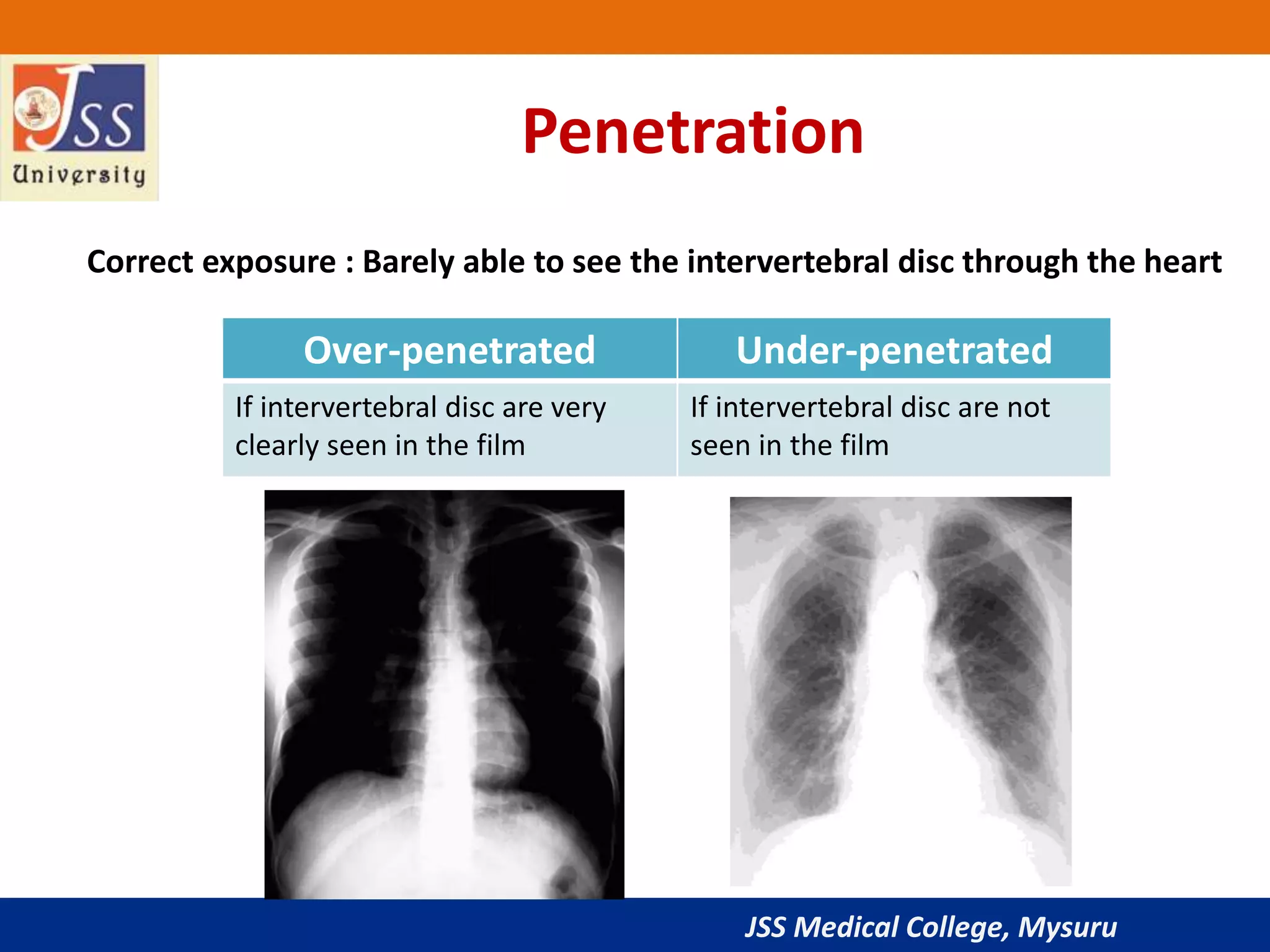 JSS Medical College, Mysuru
Penetration
Over-penetrated Under-penetrated
If intervertebral disc are very
clearly seen in the film
If intervertebral disc are not
seen in the film
Correct exposure : Barely able to see the intervertebral disc through the heart
 