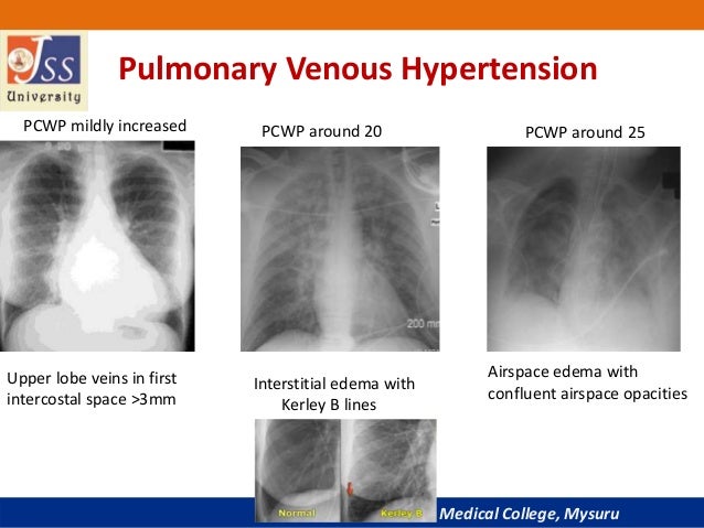 Chest x ray basic interpretation