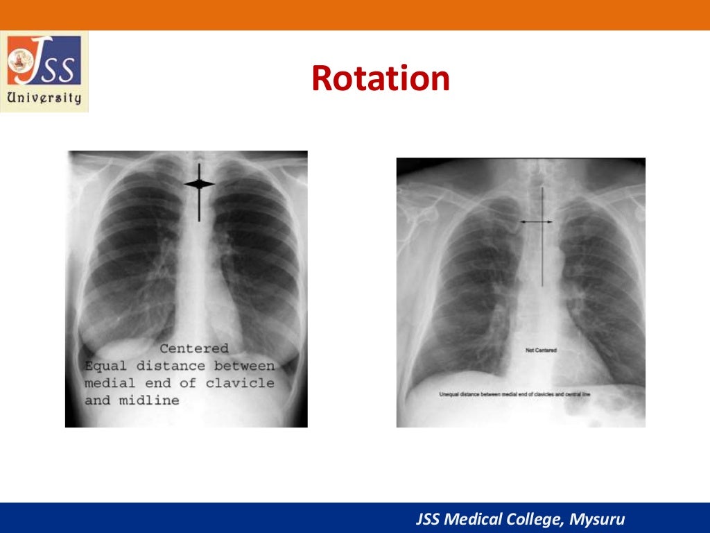 Chest x ray basic interpretation