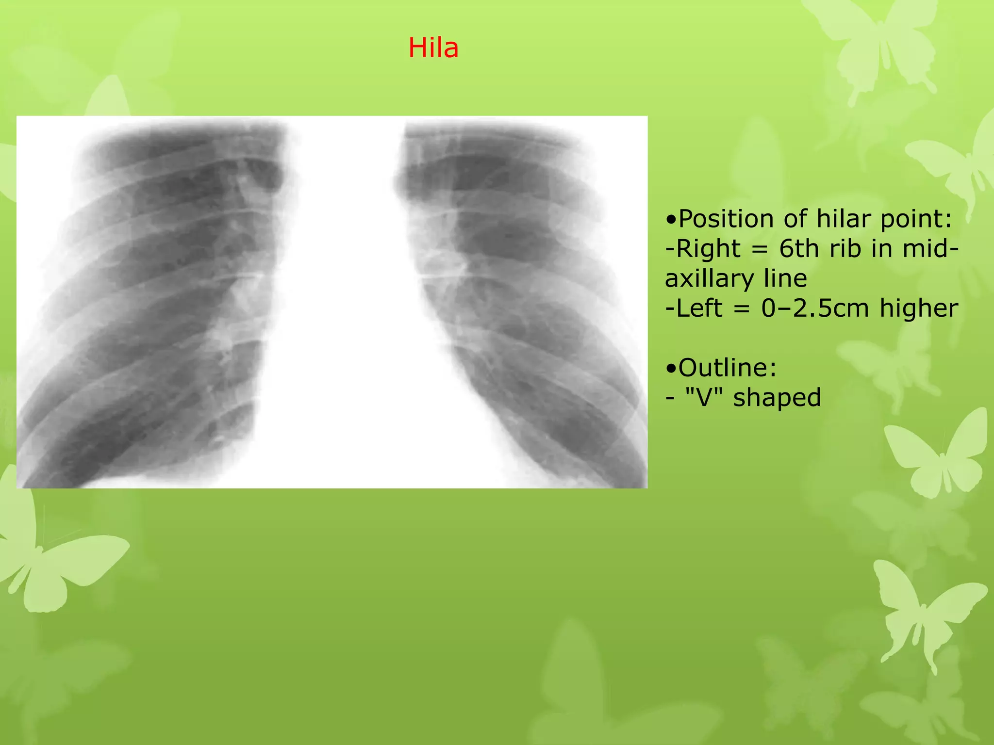 Hila




       •Position of hilar point:
       -Right = 6th rib in mid-
       axillary line
       -Left = 0–2.5cm higher

       •Outline:
       - "V" shaped
 