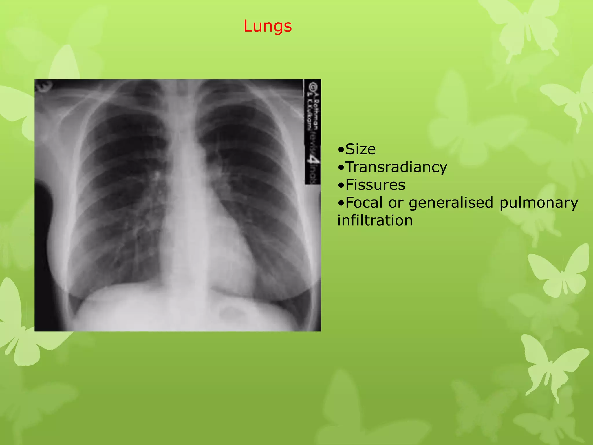 Lungs




        •Size
        •Transradiancy
        •Fissures
        •Focal or generalised pulmonary
        infiltration
 
