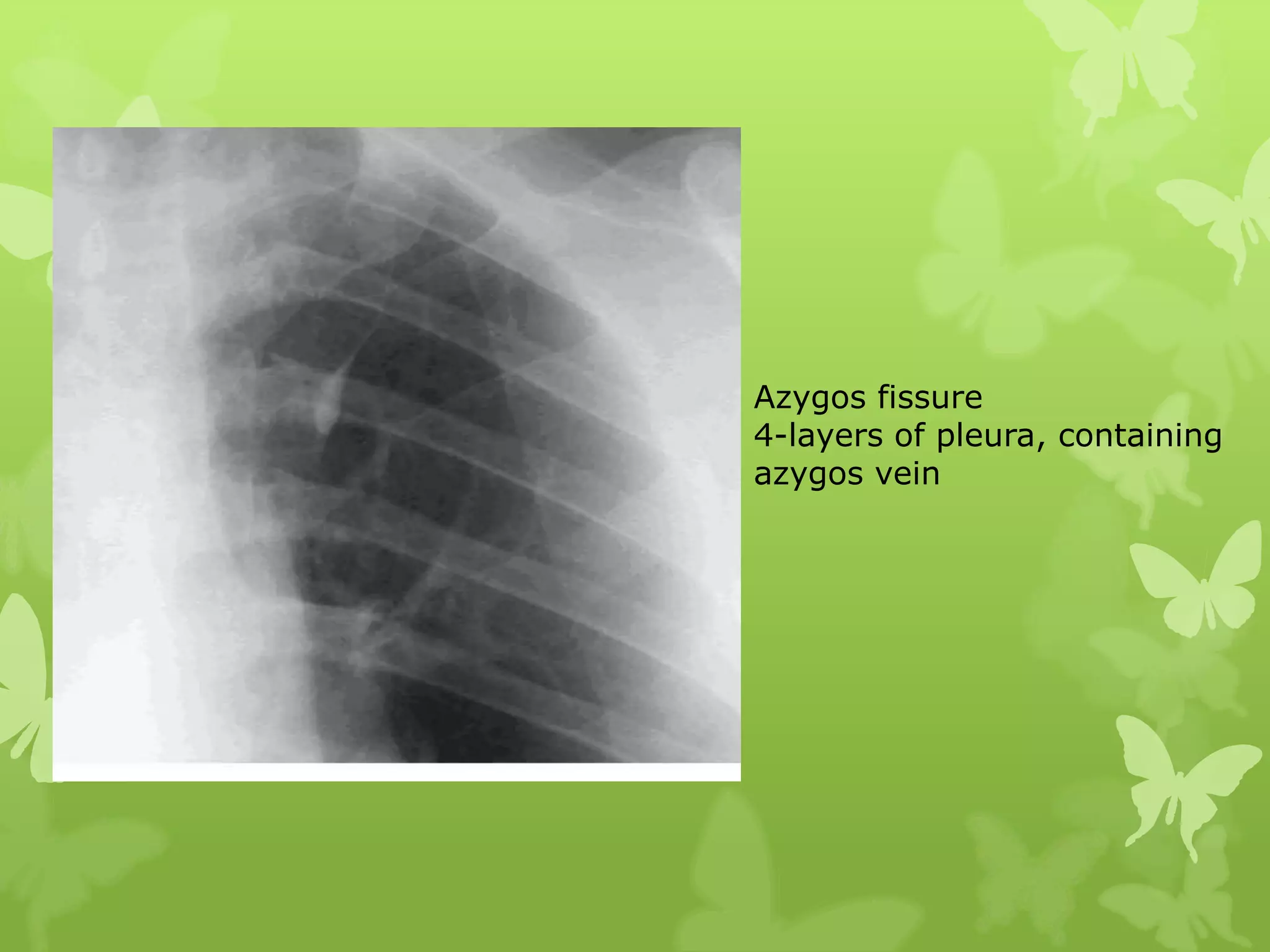 Azygos fissure
4-layers of pleura, containing
azygos vein
 