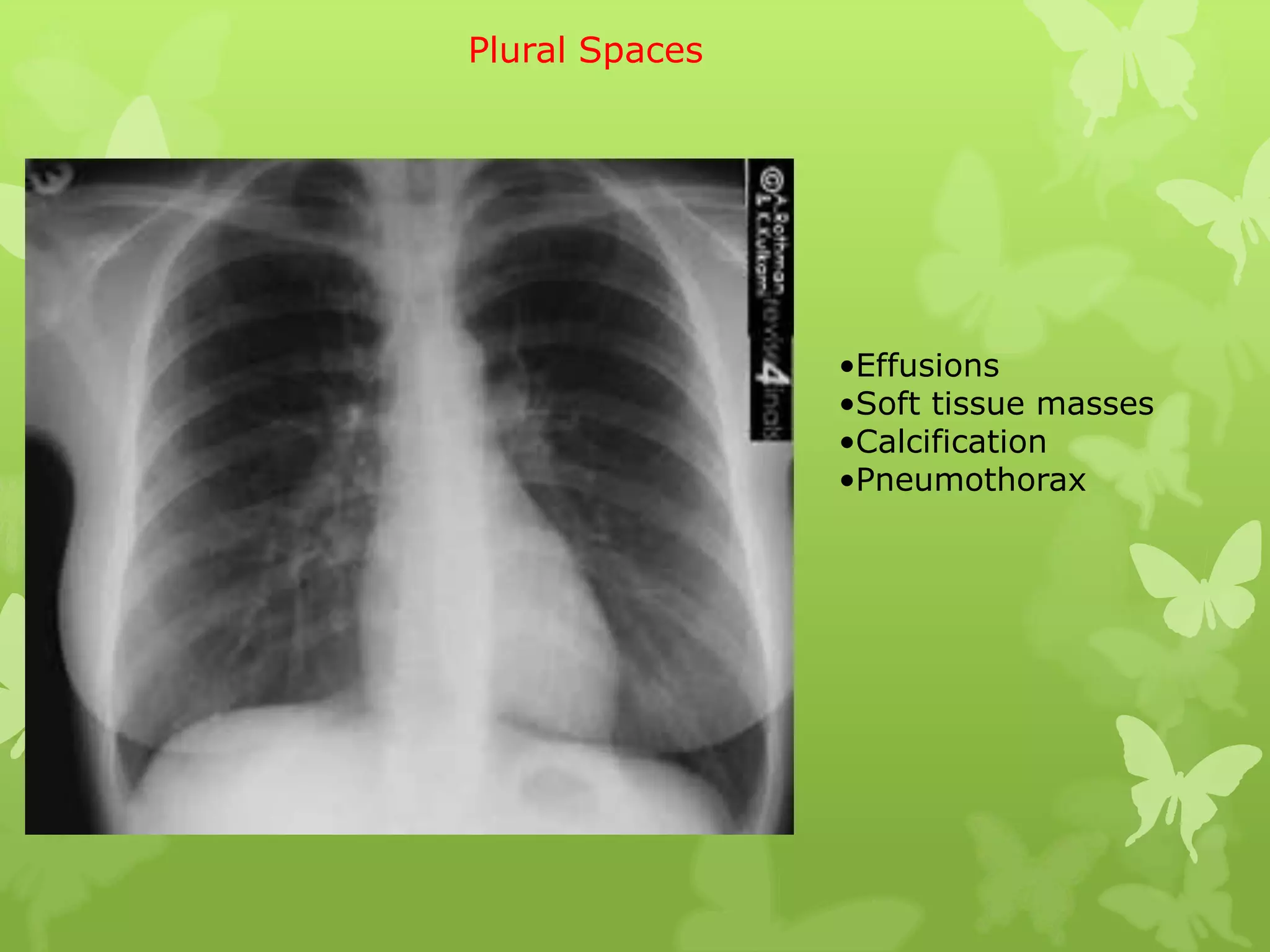 Plural Spaces




                •Effusions
                •Soft tissue masses
                •Calcification
                •Pneumothorax
 