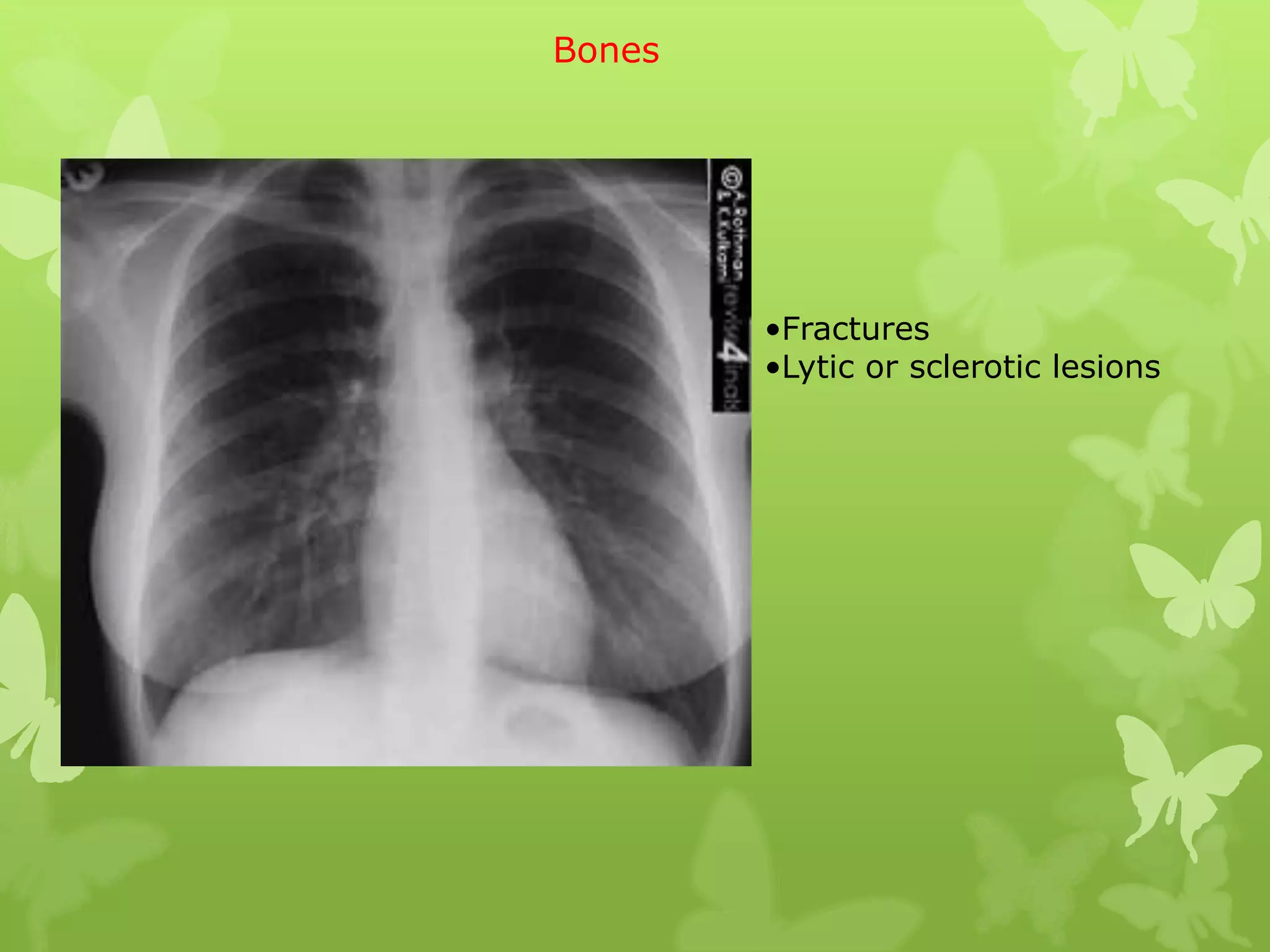 Bones




        •Fractures
        •Lytic or sclerotic lesions
 