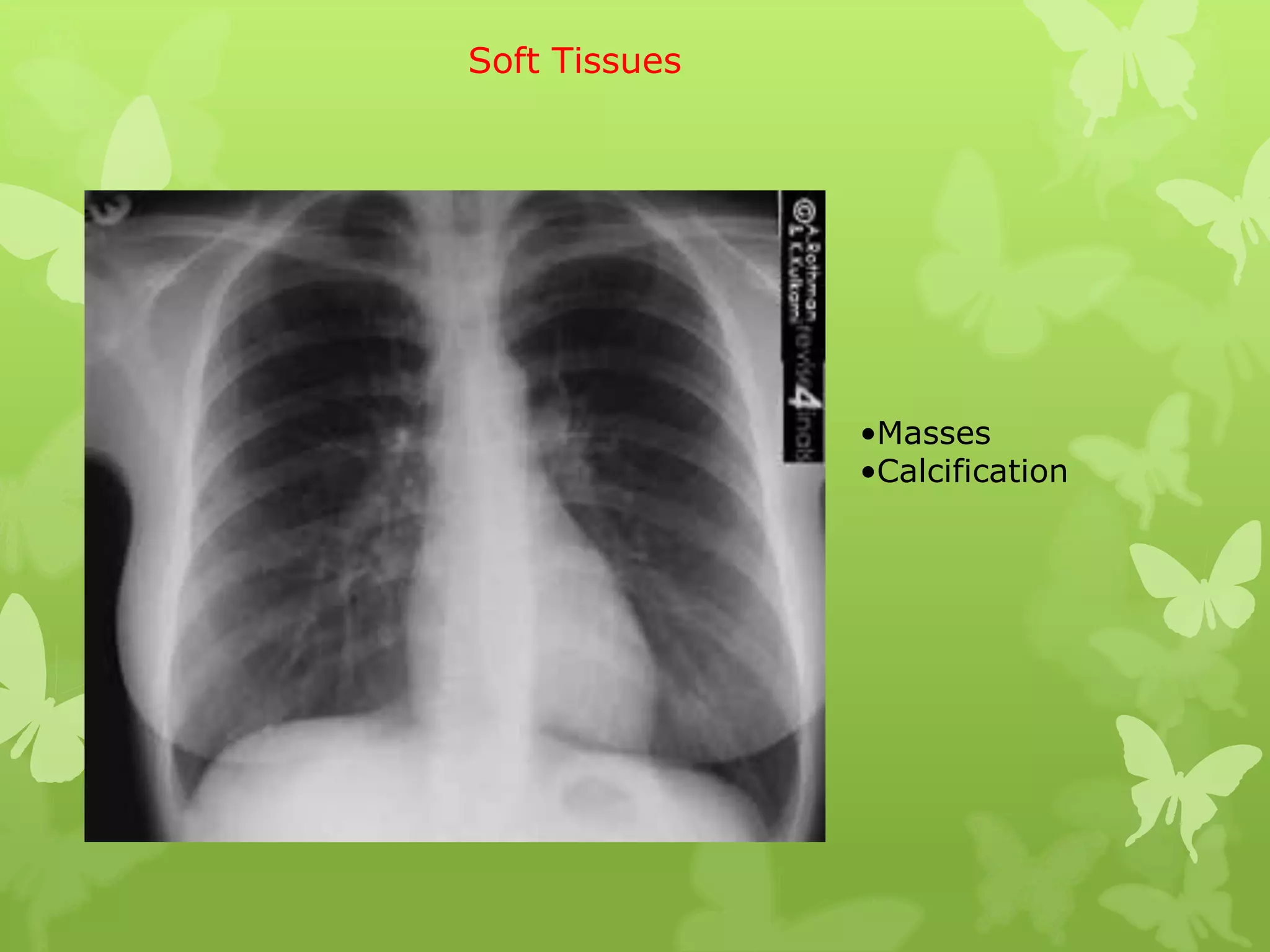 Soft Tissues




               •Masses
               •Calcification
 