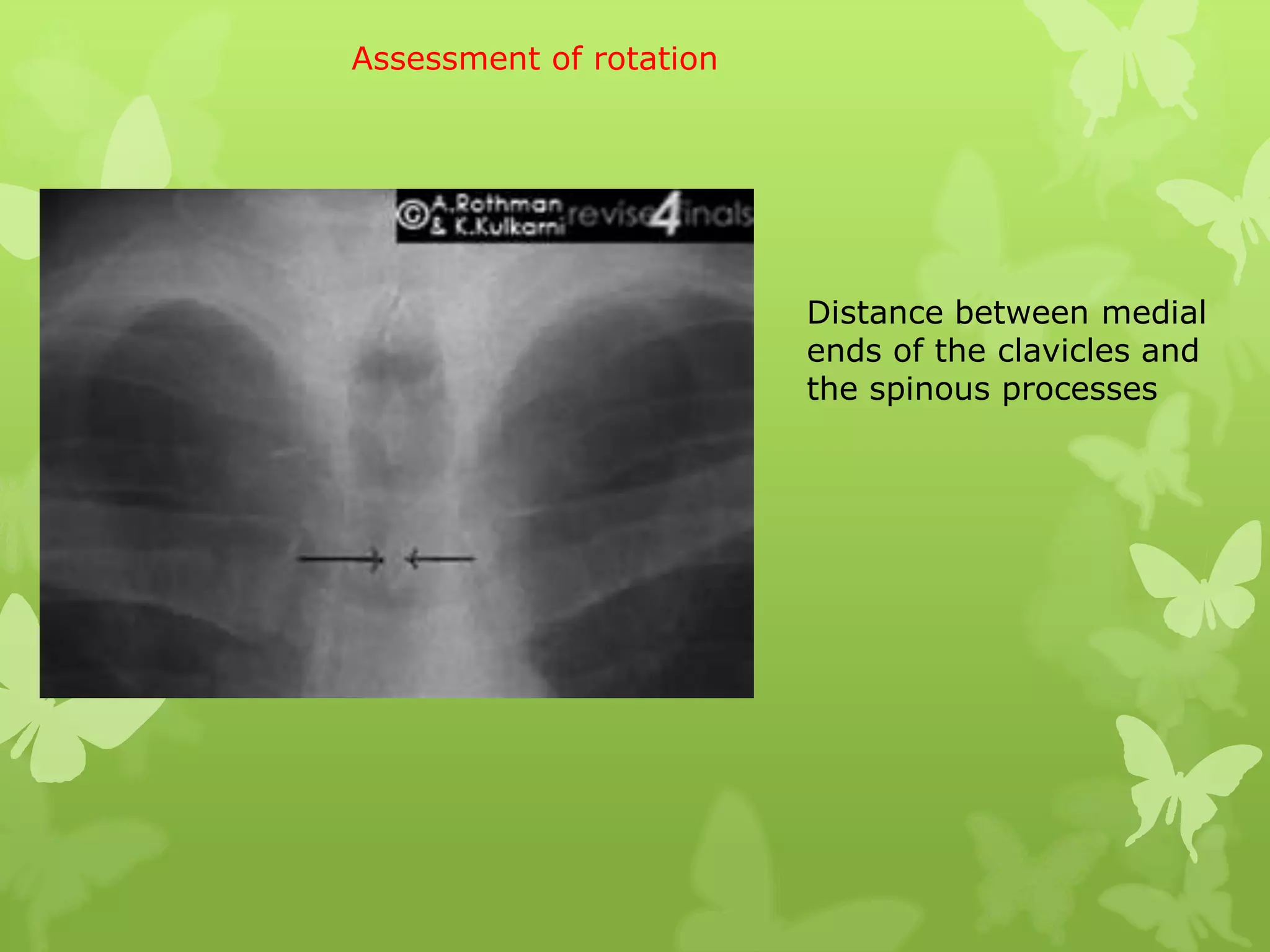 Assessment of rotation




                         Distance between medial
                         ends of the clavicles and
                         the spinous processes
 