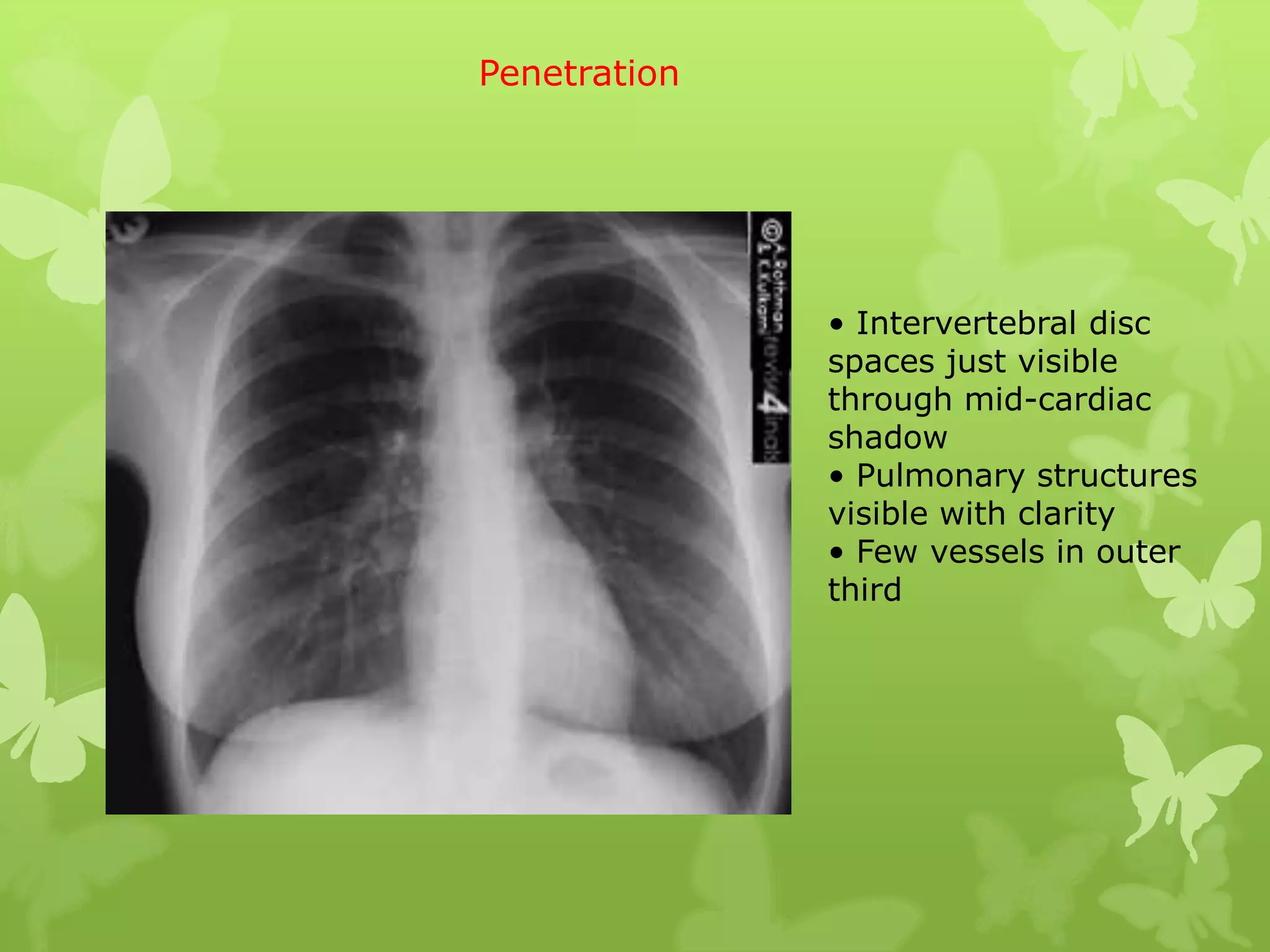 Penetration




              • Intervertebral disc
              spaces just visible
              through mid-cardiac
              shadow
              • Pulmonary structures
              visible with clarity
              • Few vessels in outer
              third
 