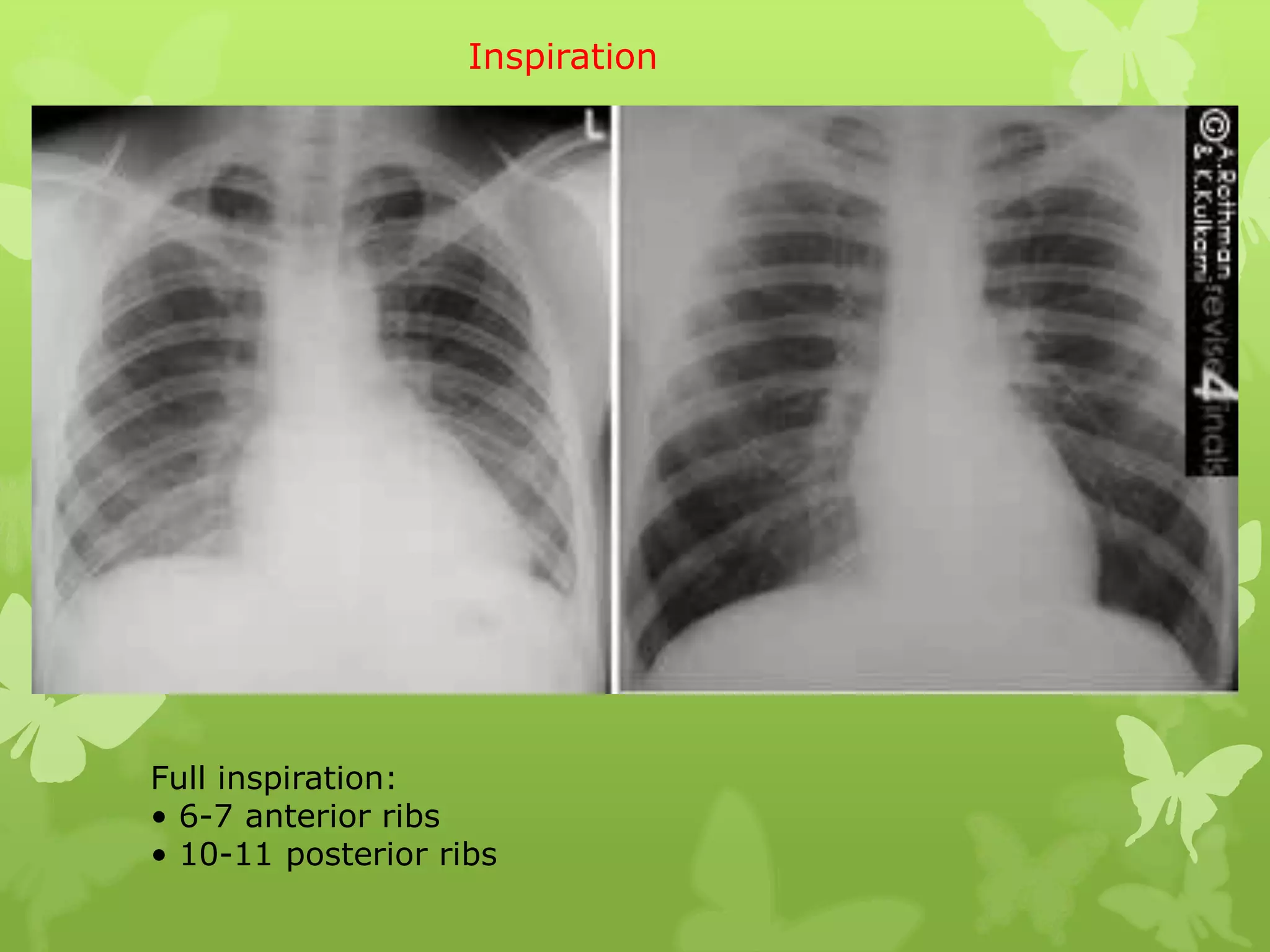 Inspiration




Full inspiration:
• 6-7 anterior ribs
• 10-11 posterior ribs
 