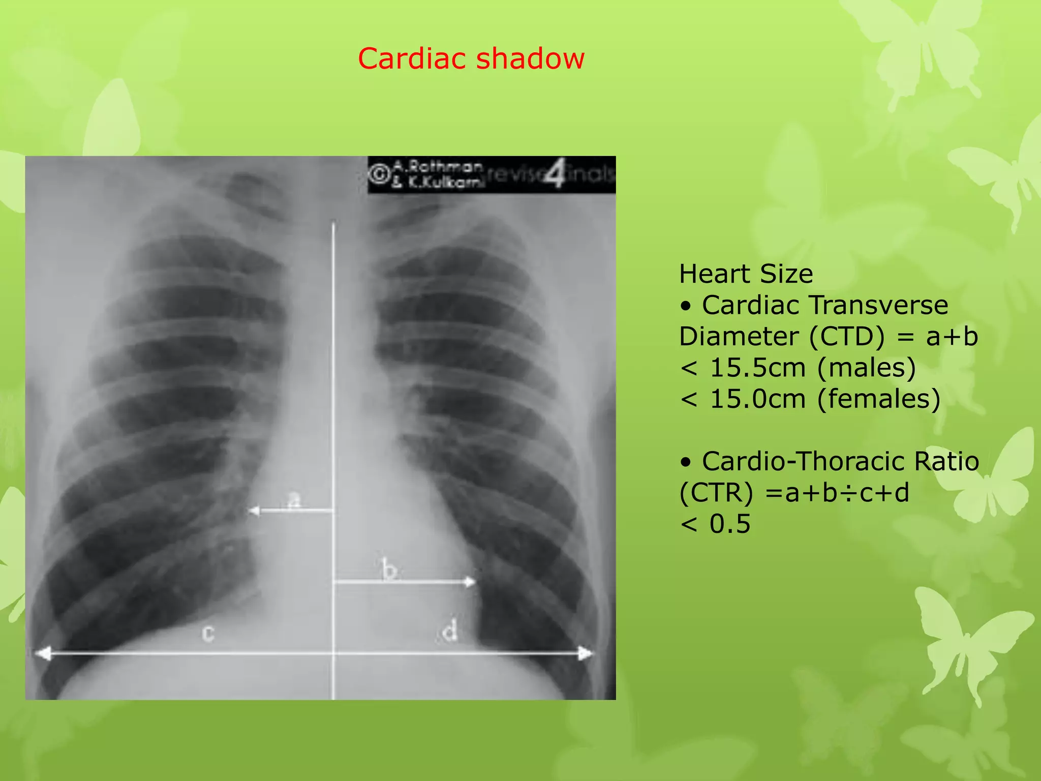 Cardiac shadow




                 Heart Size
                 • Cardiac Transverse
                 Diameter (CTD) = a+b
                 < 15.5cm (males)
                 < 15.0cm (females)

                 • Cardio-Thoracic Ratio
                 (CTR) =a+b÷c+d
                 < 0.5
 
