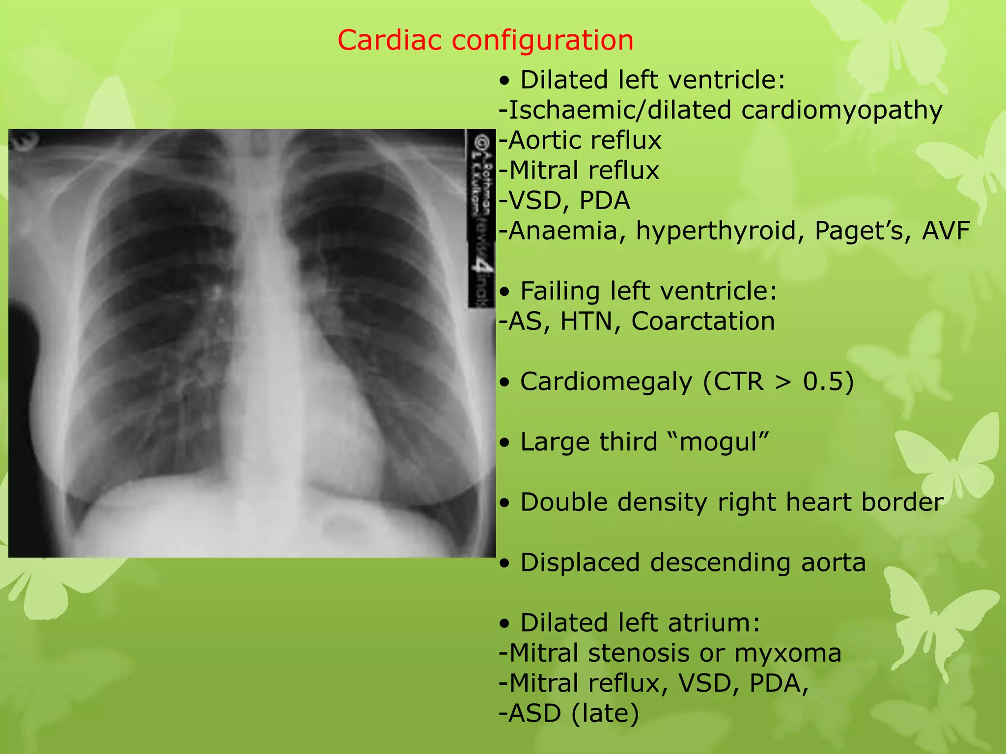 Cardiac configuration
           • Dilated left ventricle:
           -Ischaemic/dilated cardiomyopathy
           -Aortic reflux
           -Mitral reflux
           -VSD, PDA
           -Anaemia, hyperthyroid, Paget’s, AVF

           • Failing left ventricle:
           -AS, HTN, Coarctation

           • Cardiomegaly (CTR > 0.5)

           • Large third “mogul”

           • Double density right heart border

           • Displaced descending aorta

           • Dilated left atrium:
           -Mitral stenosis or myxoma
           -Mitral reflux, VSD, PDA,
           -ASD (late)
 