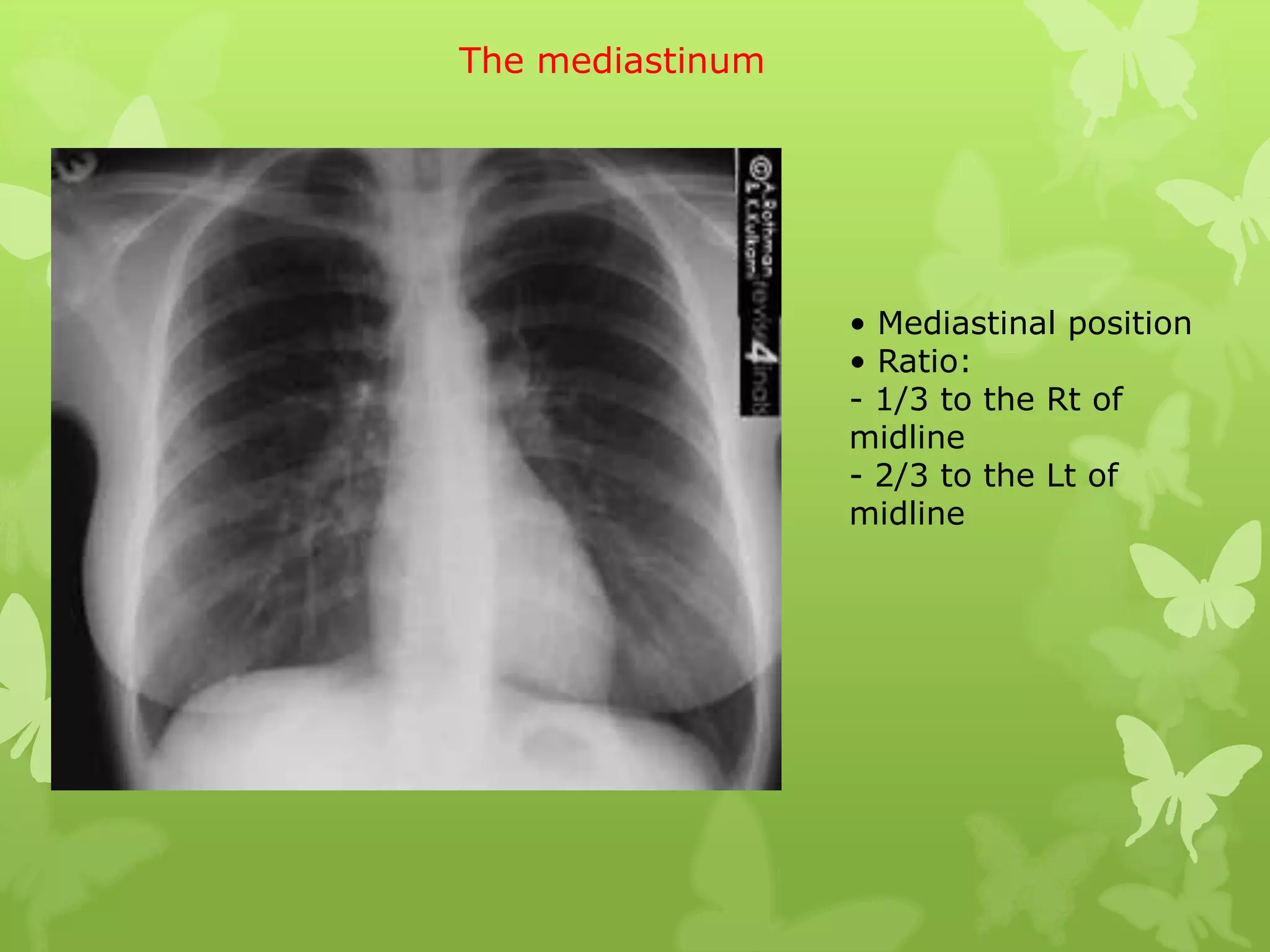 The mediastinum




                  • Mediastinal position
                  • Ratio:
                  - 1/3 to the Rt of
                  midline
                  - 2/3 to the Lt of
                  midline
 