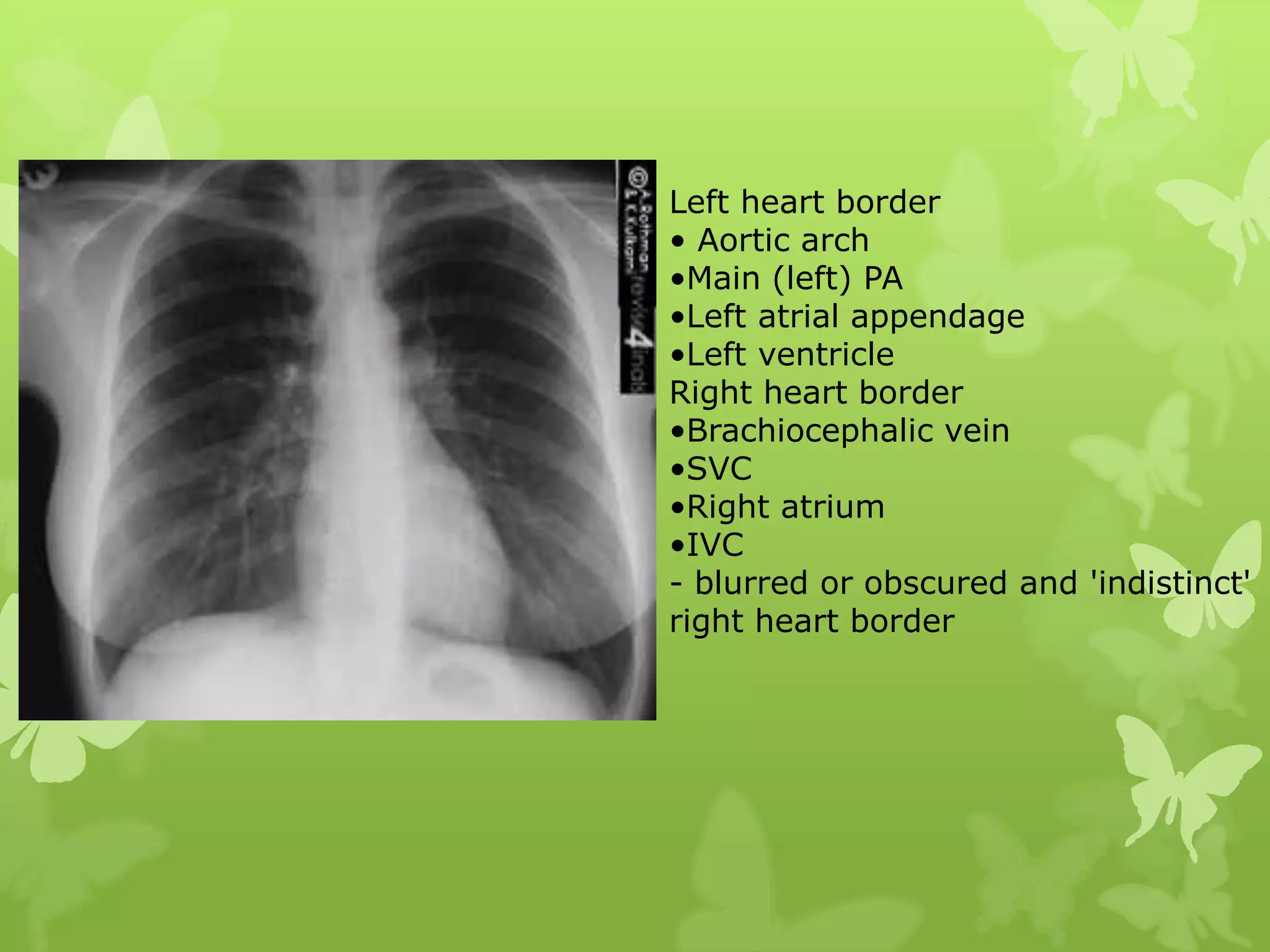Left heart border
• Aortic arch
•Main (left) PA
•Left atrial appendage
•Left ventricle
Right heart border
•Brachiocephalic vein
•SVC
•Right atrium
•IVC
- blurred or obscured and 'indistinct'
right heart border
 