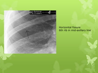 Chest x ray basics | PPTX