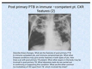 chest Xray checkmate compiled by Mwebaza victor (MBchB) for DR. Moses ...
