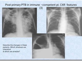 chest Xray checkmate compiled by Mwebaza victor (MBchB) for DR. Moses ...