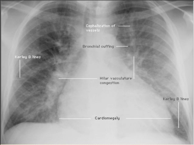 Image Result For Symptoms Of Lung Cancer Canadian Cancer Society Image Result For Symptoms Of Lung Cancer Canadian Cancer Society