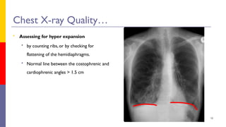 Chest Xray interpretation and normal Abdikadir Hassan .pptx
