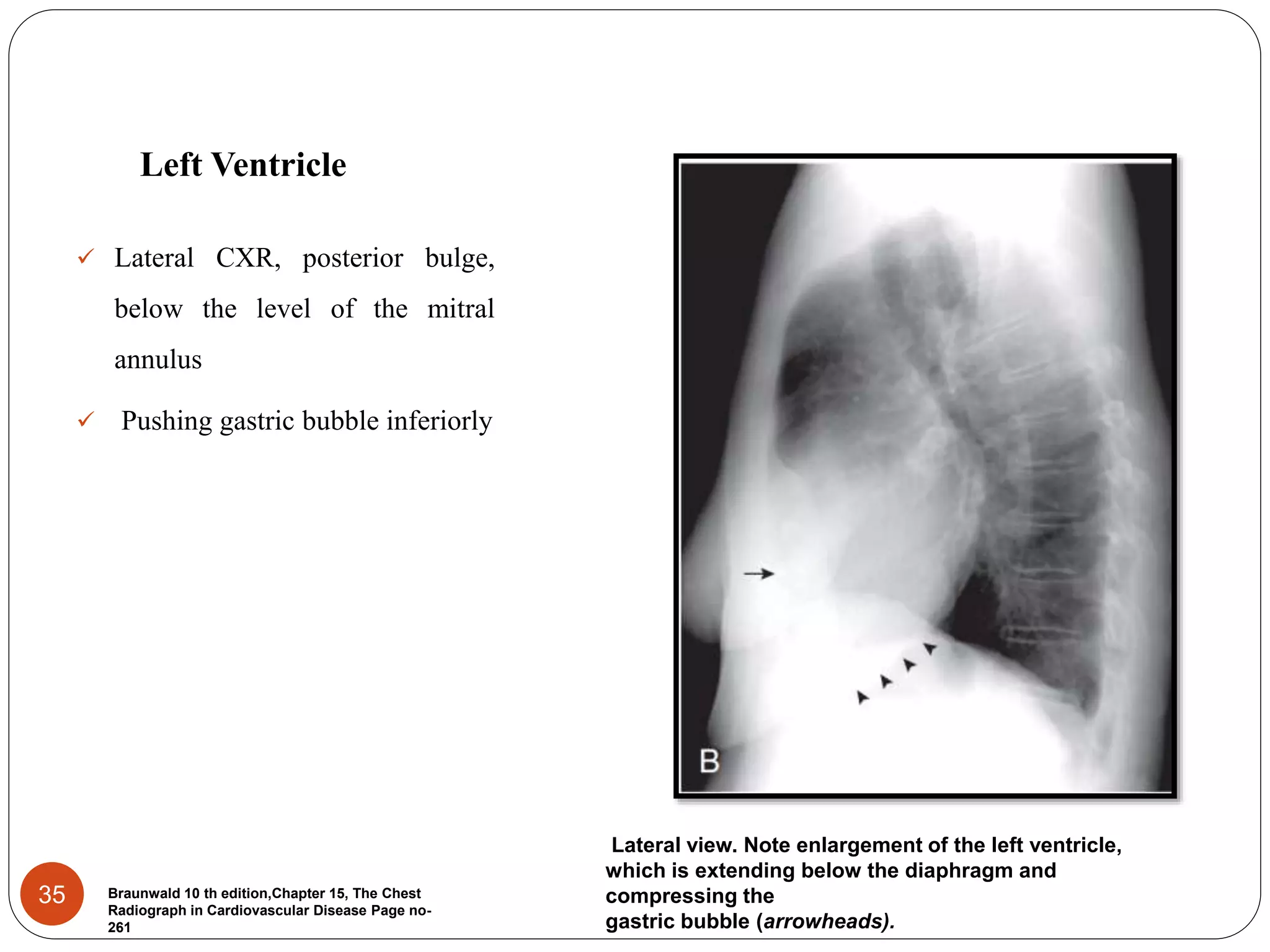 Chest xray for evaluation of cardiovascular system | PPTX