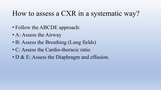 Comprehensive Guide to Chest X-Ray Interpretation Using RIPE and ABCDE ...