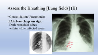 Comprehensive Guide to Chest X-Ray Interpretation Using RIPE and ABCDE ...