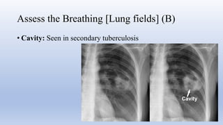 Comprehensive Guide to Chest X-Ray Interpretation Using RIPE and ABCDE ...