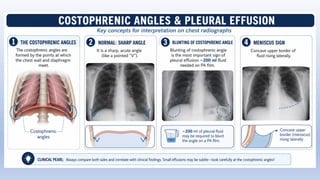 Comprehensive Guide to Chest X-Ray Interpretation Using RIPE and ABCDE ...