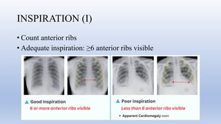 Comprehensive Guide to Chest X-Ray Interpretation Using RIPE and ABCDE ...
