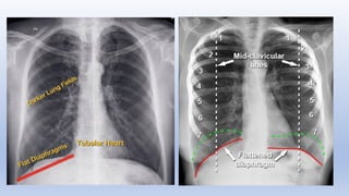 Comprehensive Guide to Chest X-Ray Interpretation Using RIPE and ABCDE ...