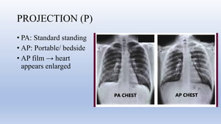 Comprehensive Guide to Chest X-Ray Interpretation Using RIPE and ABCDE ...