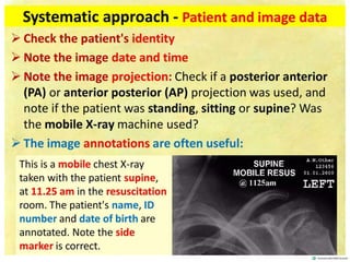 CHEST XRAY FUNDAMENTALS. Slides for The students | PDF