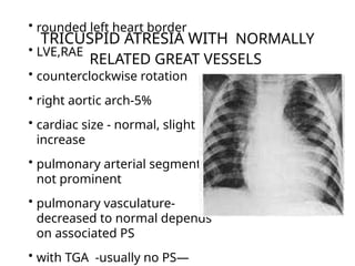 CHEST X RAY IN CONGENITAL HEART DISEASE2.pptx