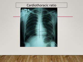 chest x ray interpretation.pptx