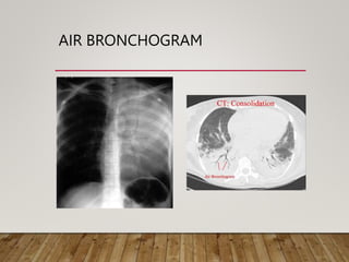 chest x ray interpretation.pptx