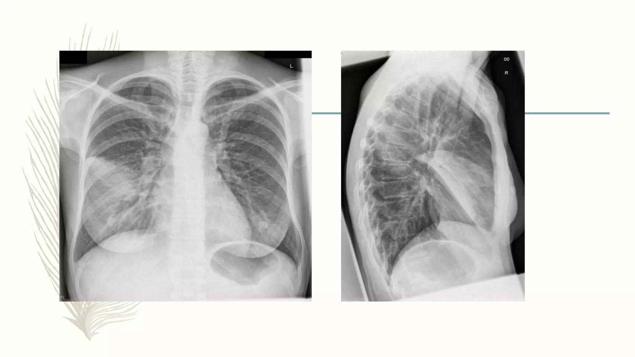 Chest x ray interpretation of infections [autosaved] | PPTX