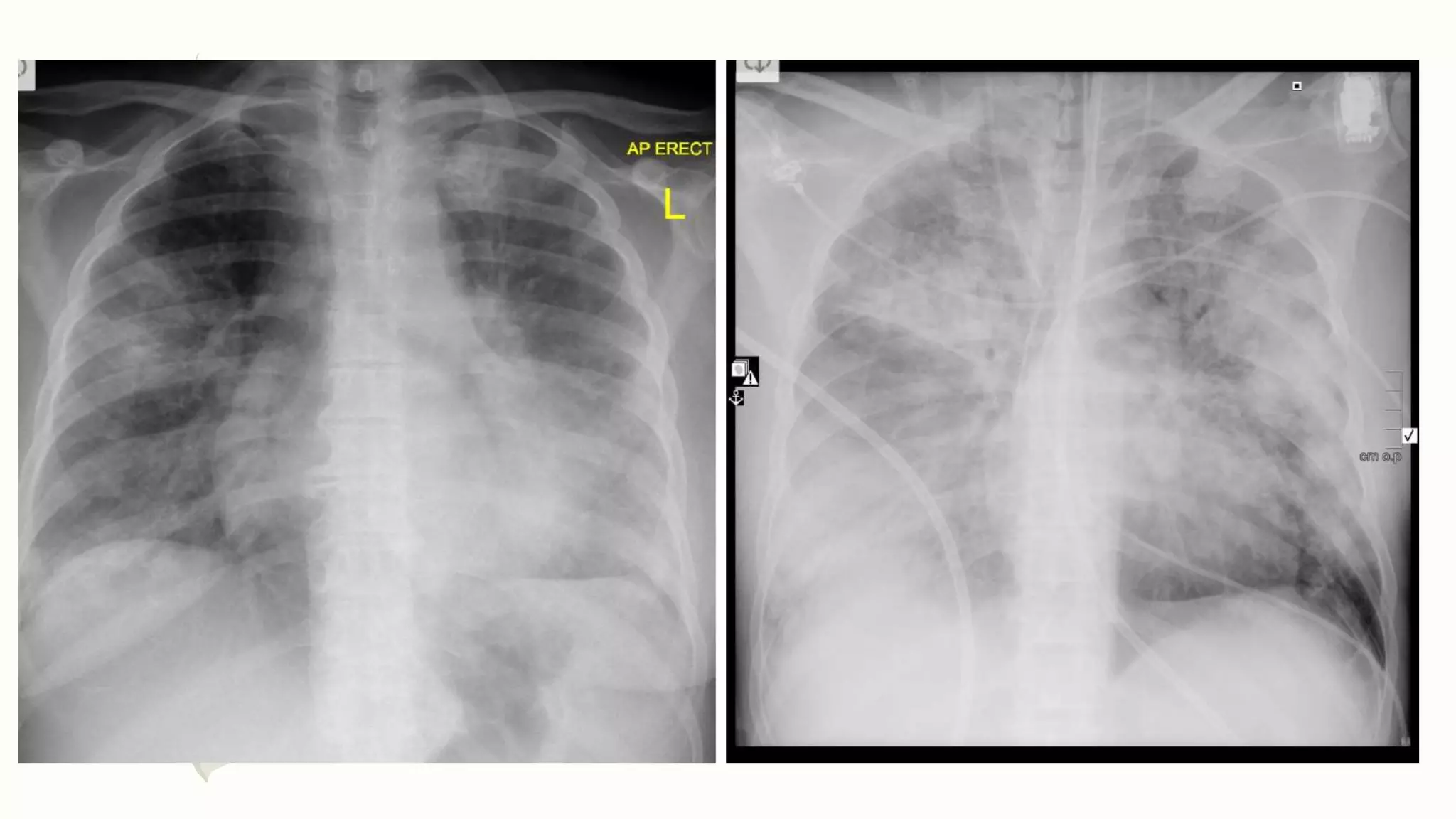 Chest x ray interpretation of infections [autosaved] | PPTX