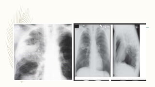 Chest x ray interpretation of infections [autosaved] | PPTX